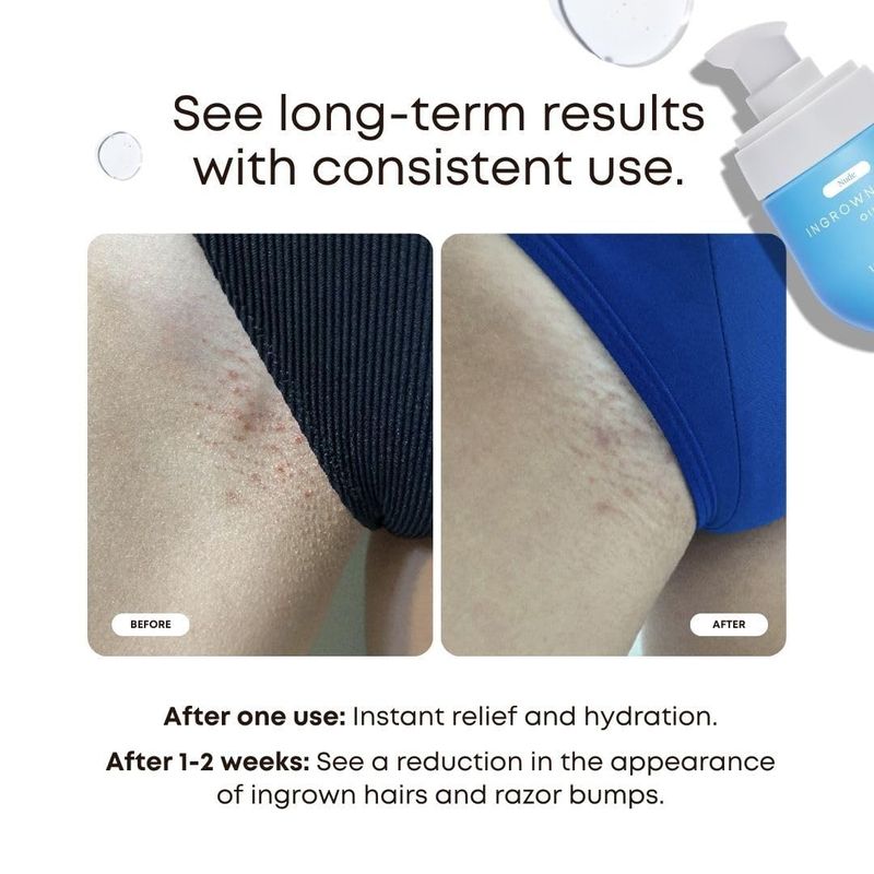 Nude Ingrown Hair Oil
